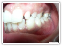 Best root canal & laser Specialist in Bhopal